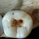 Imagen: Primera mandíbula a la que se le retiraron las caries. CC// Stefano Benazzi
